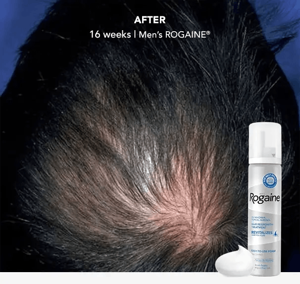 Men's Hair Regrowth Products | ROGAINE®