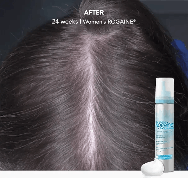 Minoxidil for hair loss What you need to know about this widely used drug  to restore hair growth  CNA Lifestyle